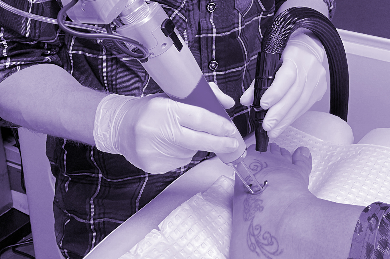 Laser Tattoo Removal - NYC & Garden City | Dr. Prasad